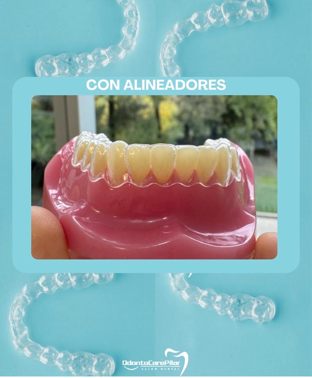 Alineadores Invisibles