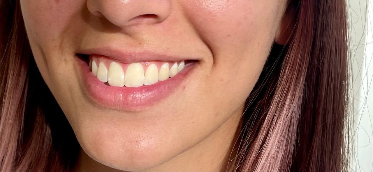 Blanqueamiento Dental